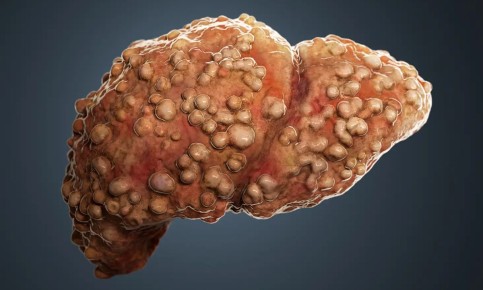 Новая исследовательская работа связывает уровень дохода с риском цирроза печени